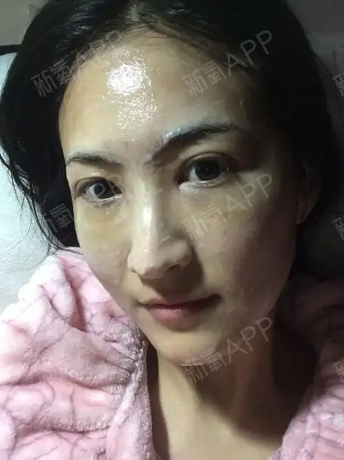 郑州自体脂肪丰泪沟好不好_效果图_夏有木兮自体脂肪丰泪沟术后第8天