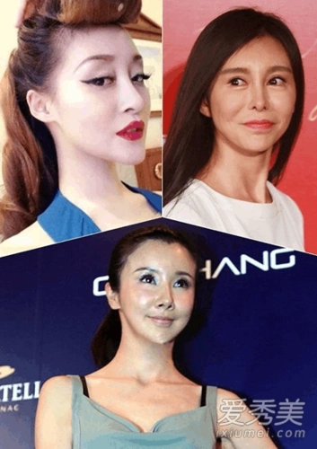 明星整容失败爆发后遗症