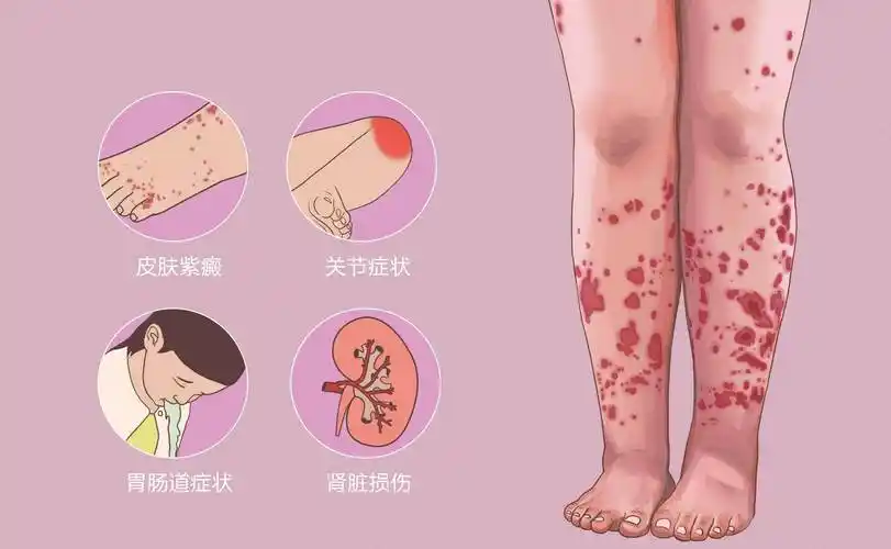过敏性紫癜为什么反反复复_患者_体质_问题