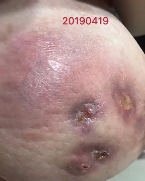 孕期突发肉芽肿性乳腺炎,生不如死