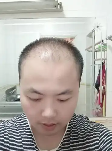年纪轻轻就脱发成这个样子,让我非常苦恼,如果我去剃光头这种头型能