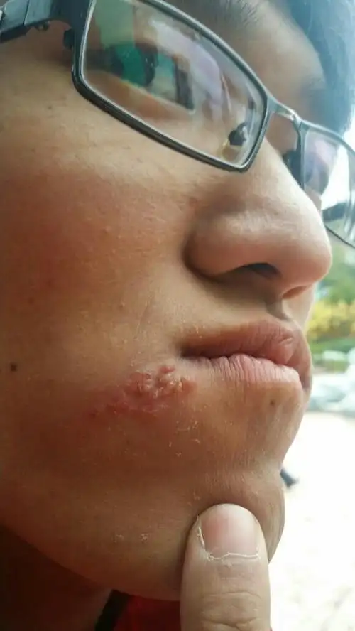 嘴角起的什么?上次洗了个澡,烫了一下有点疼,过几天就起了这东西.