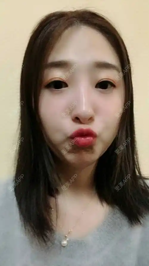 更美用户ojsckn2a6w的玻尿酸下巴日记