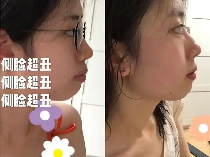 我的整牙前后对比!