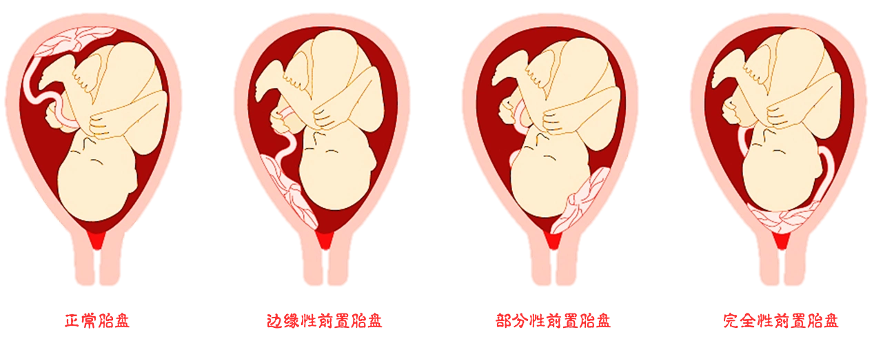 精细化围手术期多学科管理流程护航前置胎盘