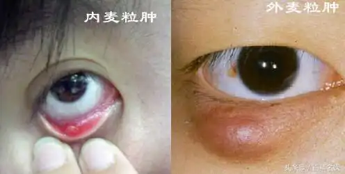 如何快速分辨是麦粒肿还是霰粒肿?