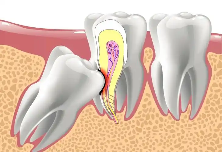 智齿又发炎了,到底拔不拔?长期出现这几个问题,建议拔了!