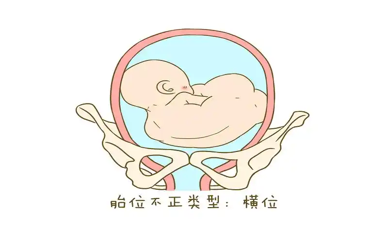 胎儿横位示意图