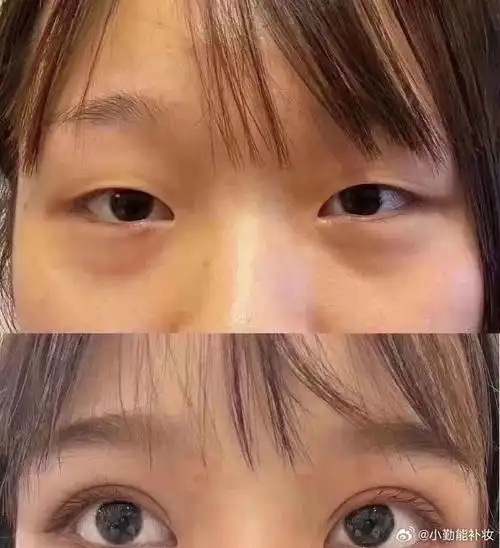 在选择双眼皮手术时,我们需要考虑个人的需求,适合自己的设计方案以及