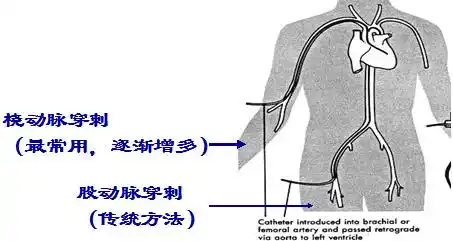 冠脉造影的穿刺途径绝对的技术贴