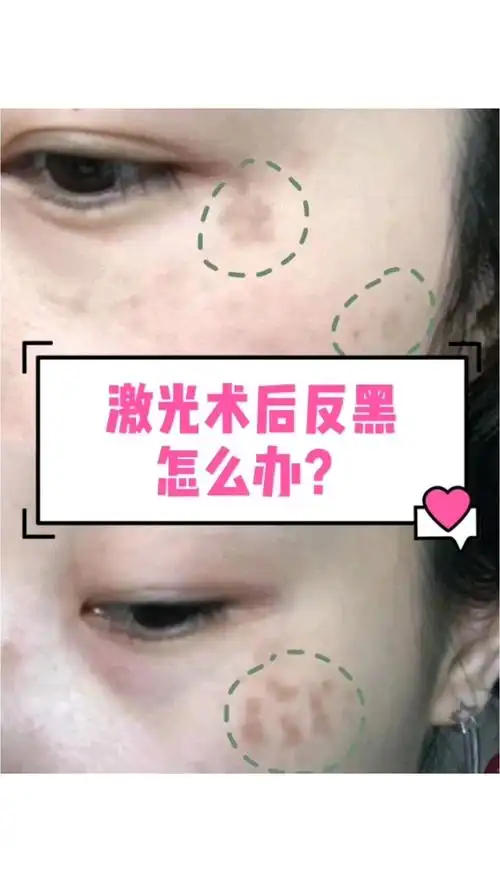 激光术后反黑怎么办?激光美白,祛斑,明明想要更白,_圈子-新氧美容整形