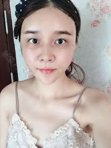 新氧- 秀是你笨吧 | 自体脂肪填充全脸 | 术后当自强 | 重庆同城