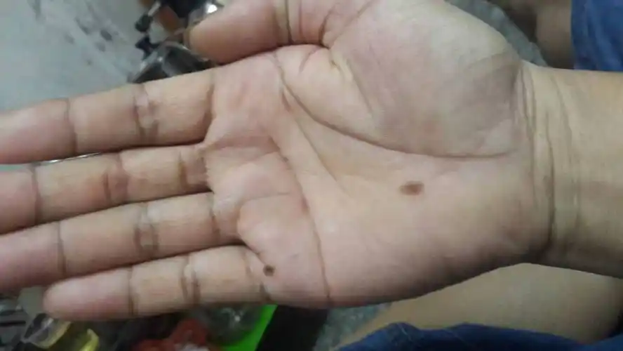 男人左手掌中有黑痣(男人左手掌长痣代表什么)