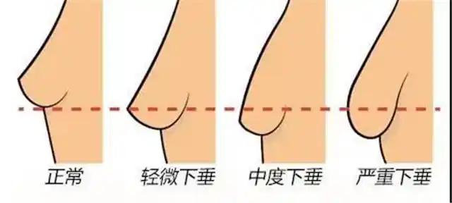 母乳喂养胸部下垂真相居然是