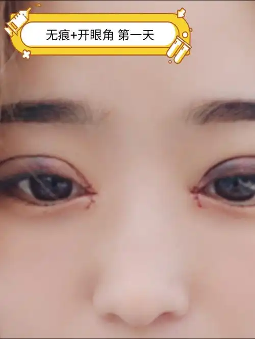 今天刚做了无痕双眼皮开眼角