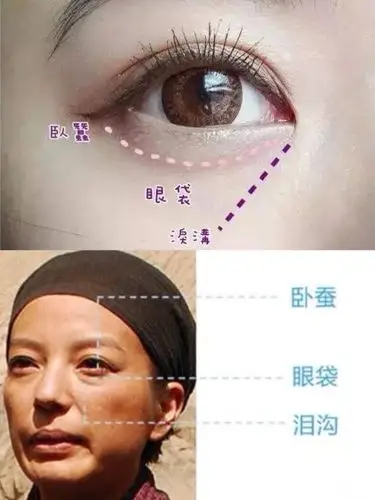 眼袋卧蚕泪沟黑眼圈傻傻分不清