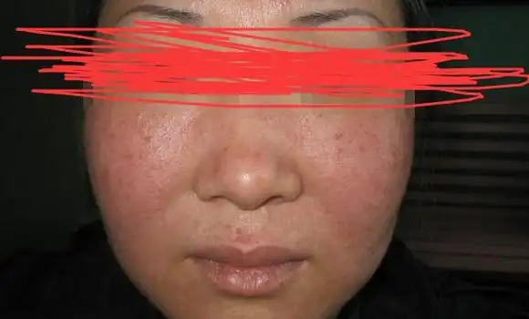 怎么判断是螨虫咬的包,红疹痘疮在夜间瘙痒(螨皮炎症状图片) — 神奇