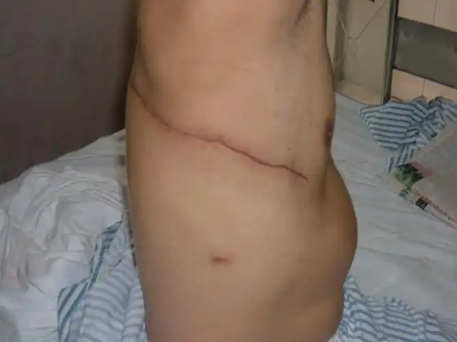 开胸切口微创切口漏斗胸微创手术(nuss手术)术前术后手汗症微创手术