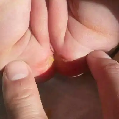 17天婴儿 屁眼发红 破皮 怎麼办?