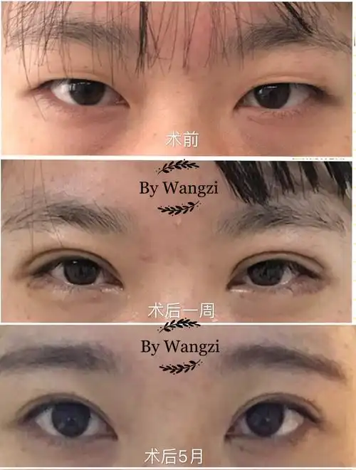 双眼皮,开眼角术前术后对比照片 - 好大夫在线