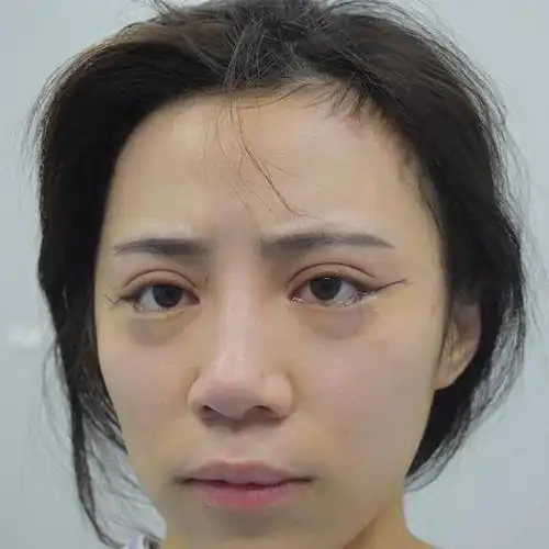 老被人嘲笑眼睛丑,做了双眼皮开眼角,发现更丑了