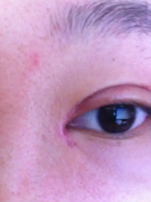 开眼角加双眼皮差不多三周,眼角部分增生了,这真.