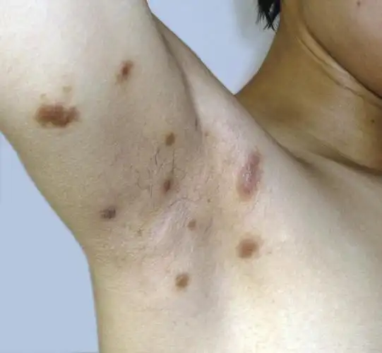 皮肤性病科图谱非感染性肉芽肿结节病