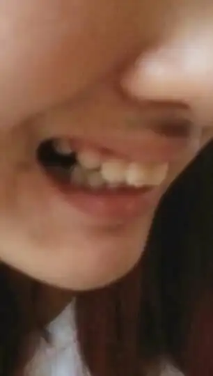 问了牙医,牙医说上颚突出,只带牙套还是会龅牙,说要动刀,但对牙齿非常