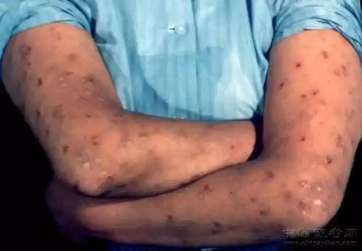 密集恐惧症及非医护人员慎点!史上最全的皮肤病图谱来了(修订版)!