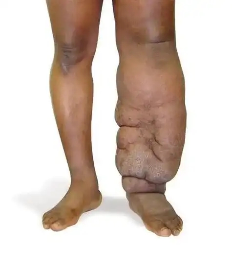 护理团体标准解读:乳腺癌术后淋巴水肿预防和护理 —中华护理学会肿瘤