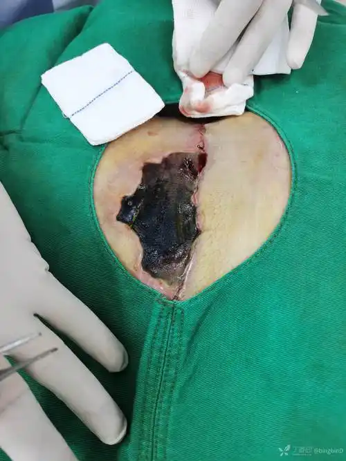 乳腺癌术后皮肤坏死