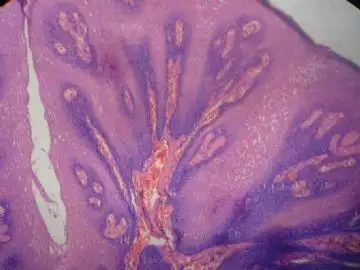 悬雍垂乳头状瘤?