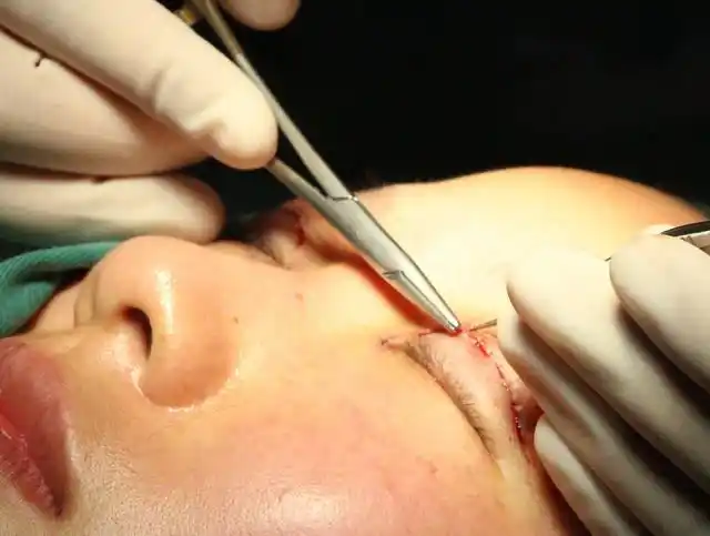 这5种眼睛割双眼皮,效果美爆了