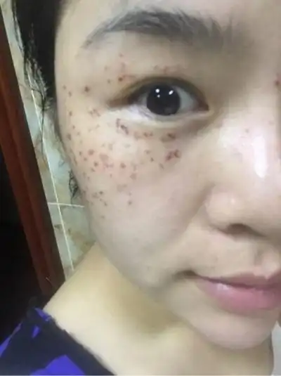 激光祛斑后反黑图片6