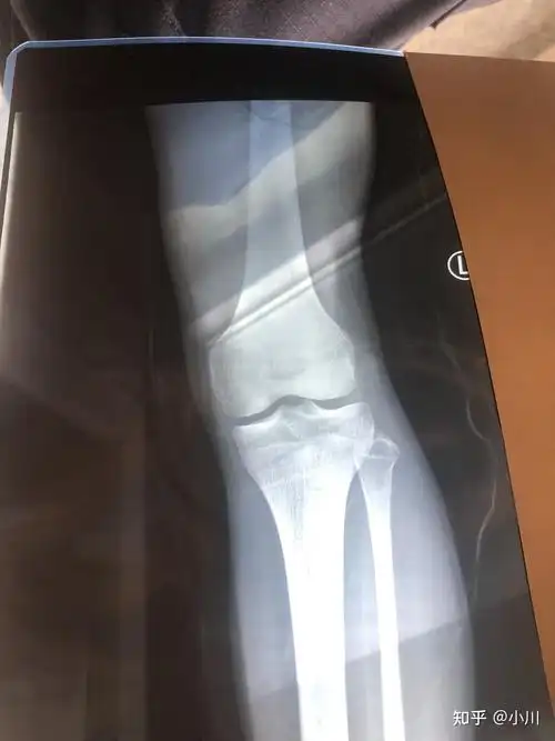 骨骺线闭合了为什么还在涨? - 知乎