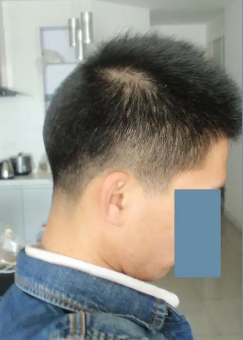 我的后脑咋这么丑啊 出来了一块 这个算是反骨么.这是个啥说法