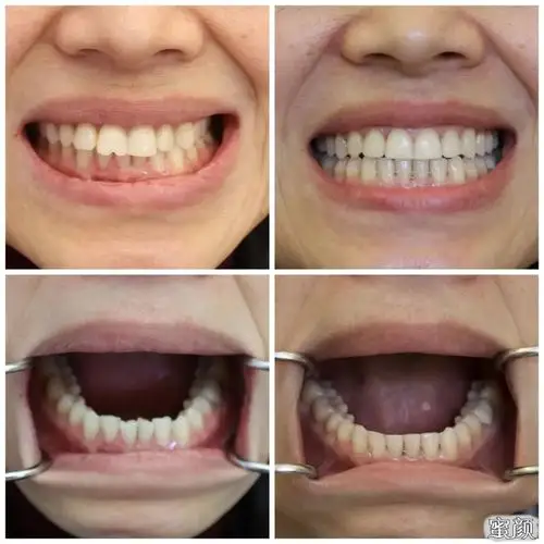 牙齿矫正前后对比实在太大啦!30多岁都不算晚!