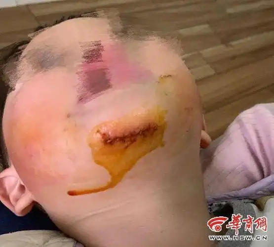 谁的责任西安2岁幼童在幼儿园下巴受伤缝20多针后续还得美容治疗