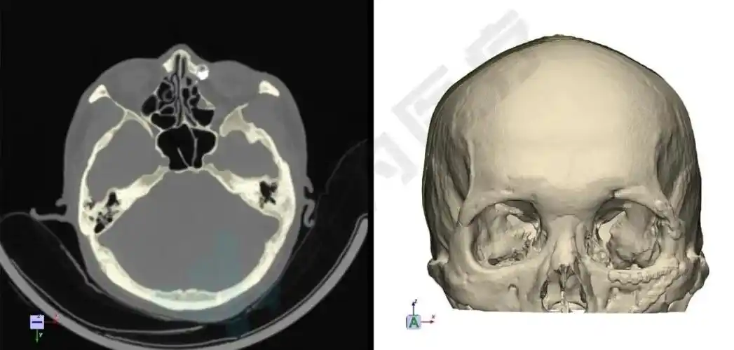 三维重建头颅模型
