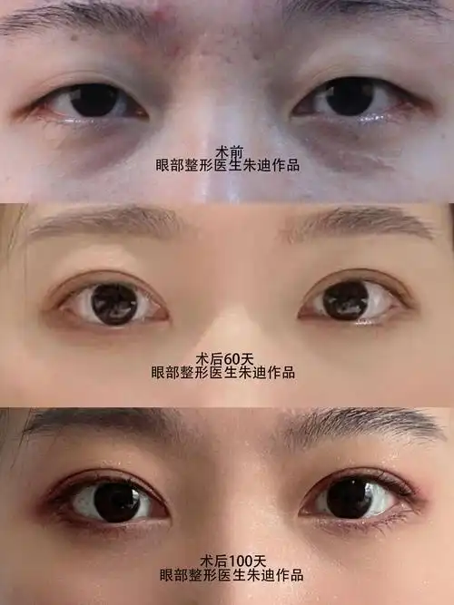 做双眼皮开眼角术后注意事项,一般开眼角和做双眼皮多少钱