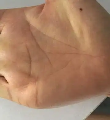 金星丘有痣,审美感非常好,异性缘不错,在爱情上比较热情,桃花运好.