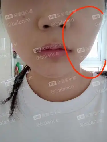 刚拔完我感觉我的脸肉眼可见的塌了下去,但姐妹们,有很多人拔完都会肿