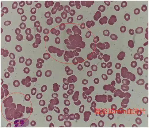 遇到红细胞冷凝集的应对措施