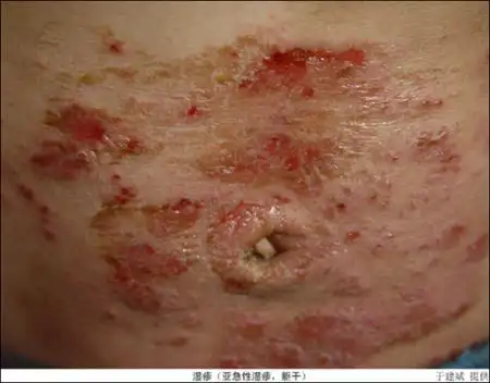 乳房湿疹的临床表现