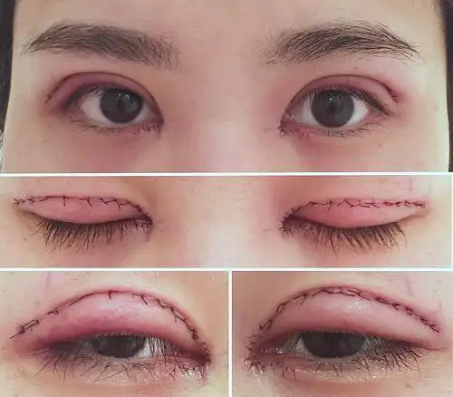 超级详细高清图 全切双眼皮 开眼角