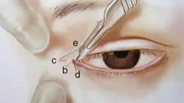 开外眼角费用(开外眼角过程图解)