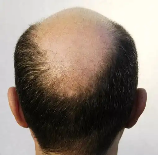 基因引起的雄激素脱发只会顶部头发稀疏和发际线后移外,后脑勺的两侧
