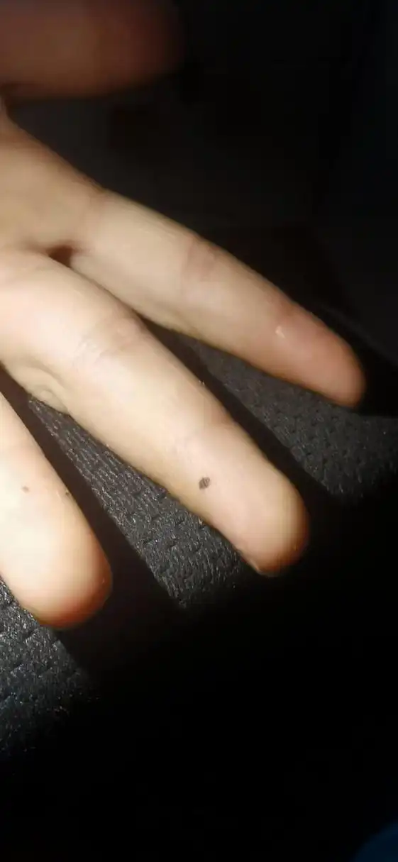 宝宝手指长痣,怎么办啊?