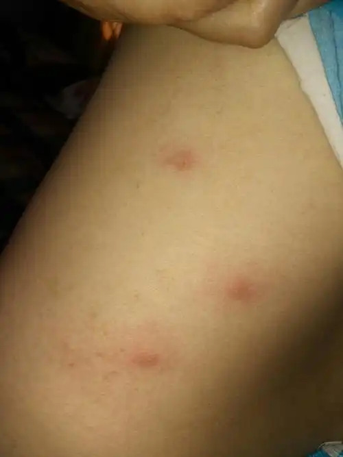 被跳蚤咬了,怎么才能好的更快,难受死了