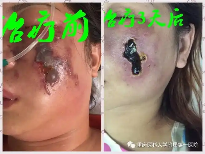 【重医一院科普】乱挤小疖子,"挤"出了败血症